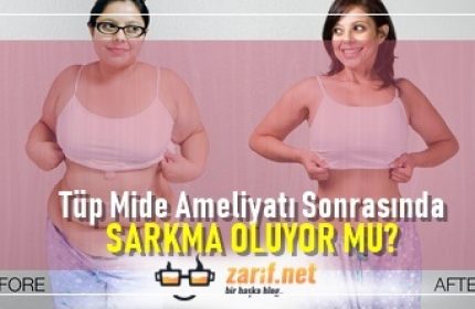Tüp Mide Ameliyatı Sonrasında SARKMA OLUYOR MU?